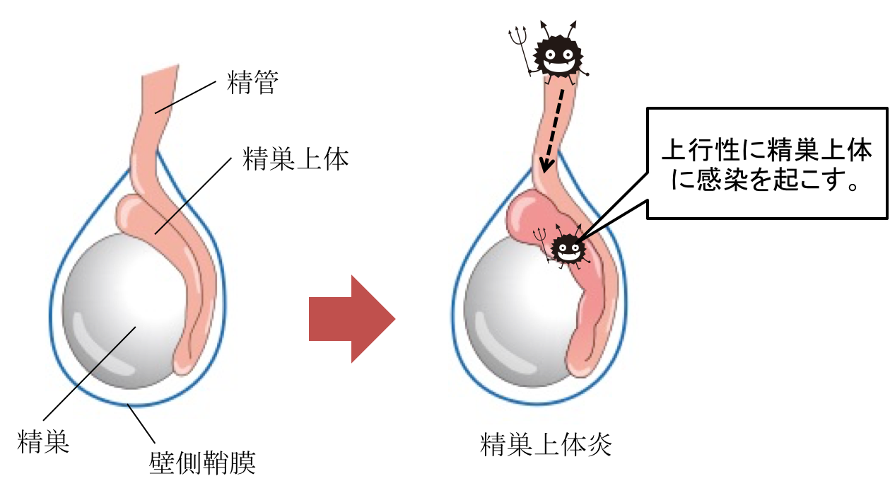 MRI画像あり】精巣上体炎の原因や症状、治療法を徹底解説！